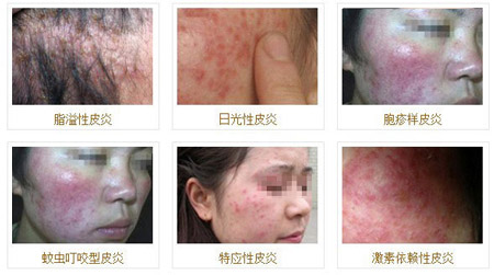 兰州北大皮肤病专科